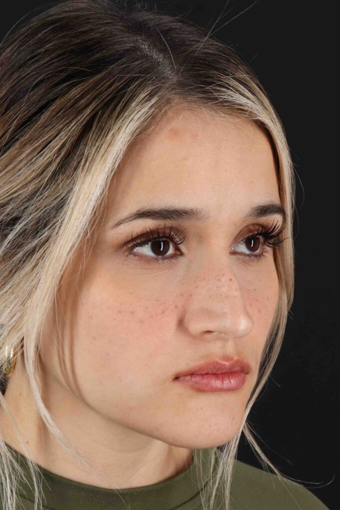 Before - right_oblique