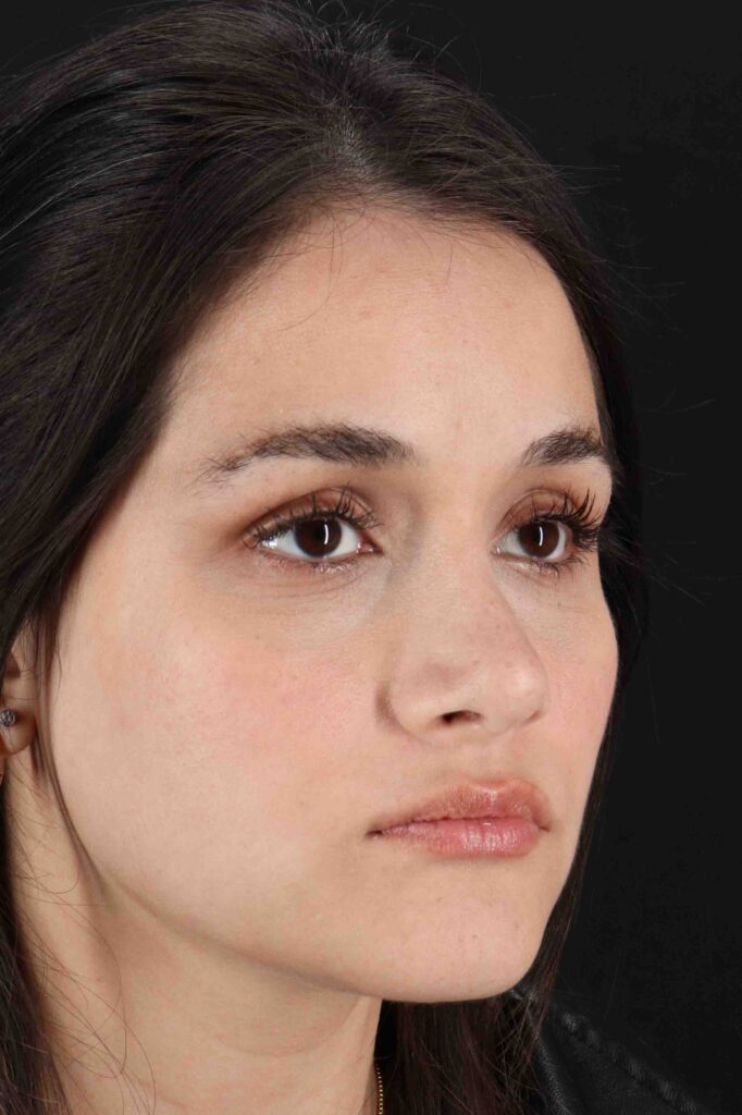 After - right_oblique