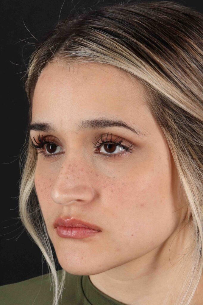 Before - left_oblique