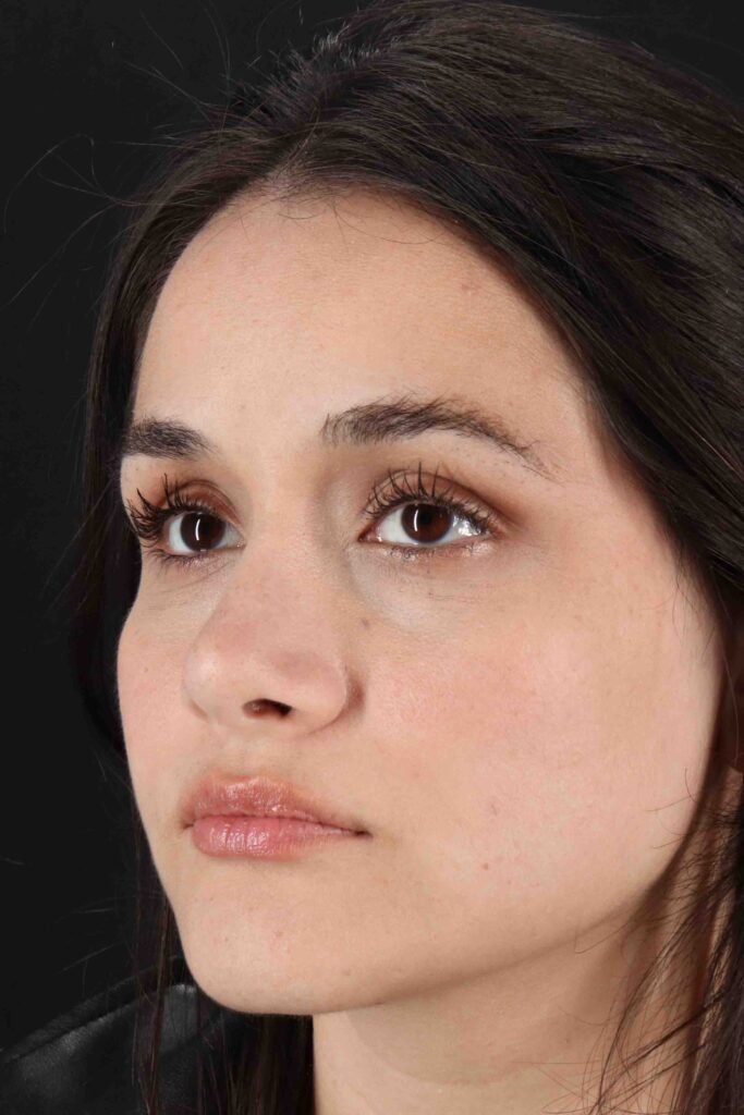 After - left_oblique