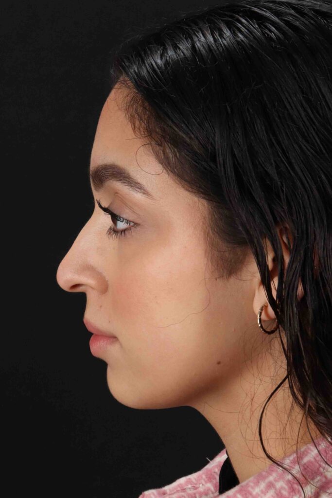 Before - left_lateral