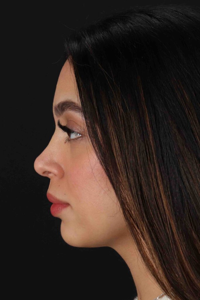 After - left_lateral