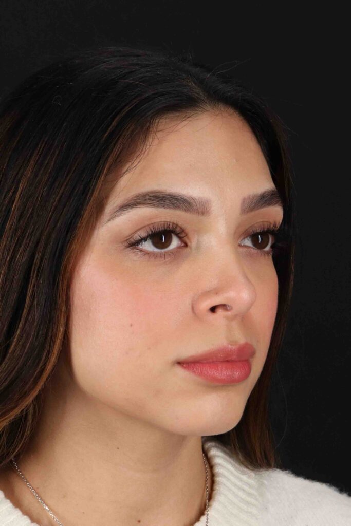 After - right_oblique