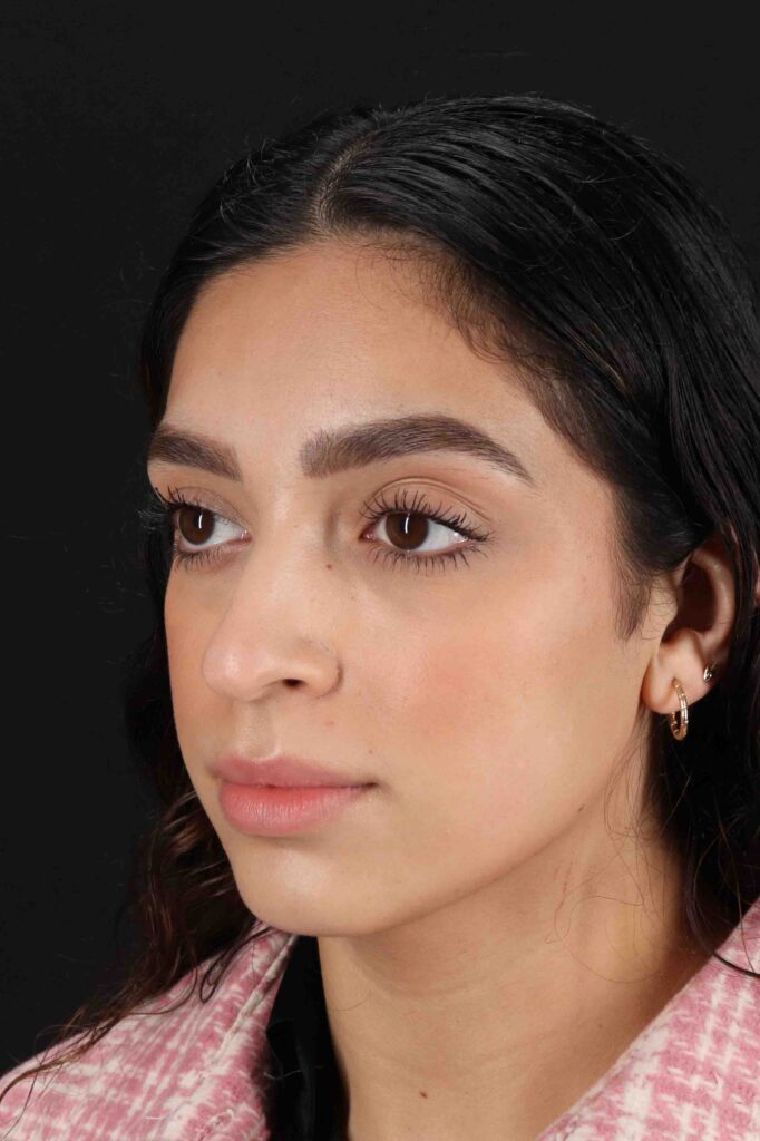 Before - left_oblique