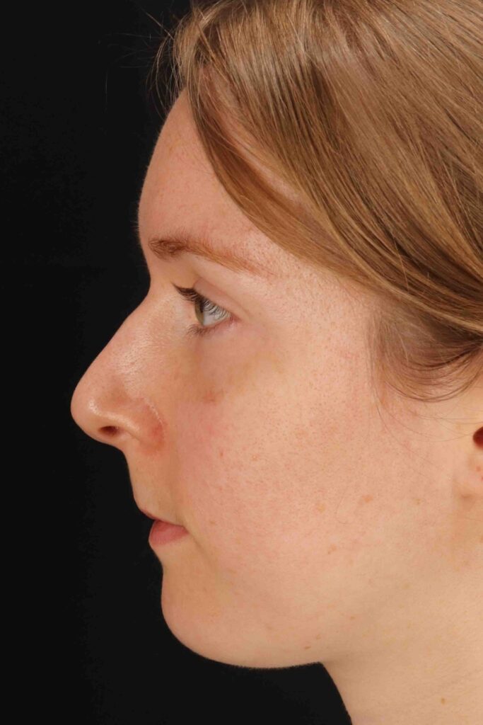 Before - left_lateral