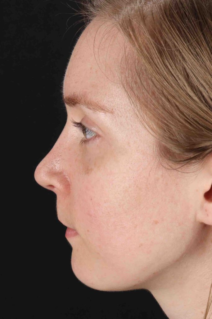 After - left_lateral