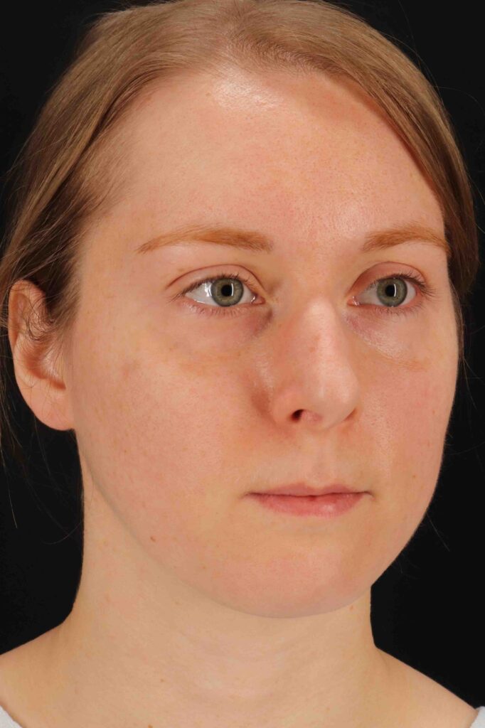 Before - right_oblique