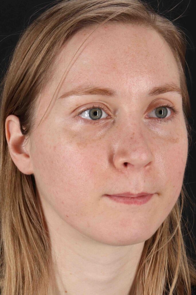 After - right_oblique