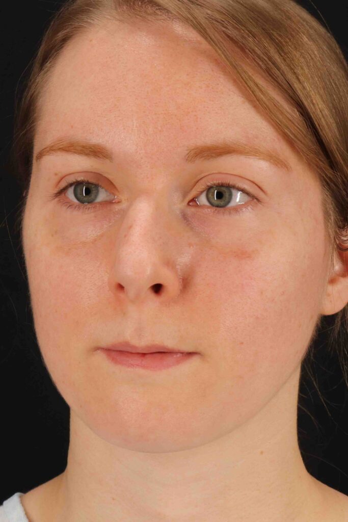 Before - left_oblique