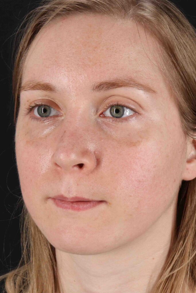 After - left_oblique