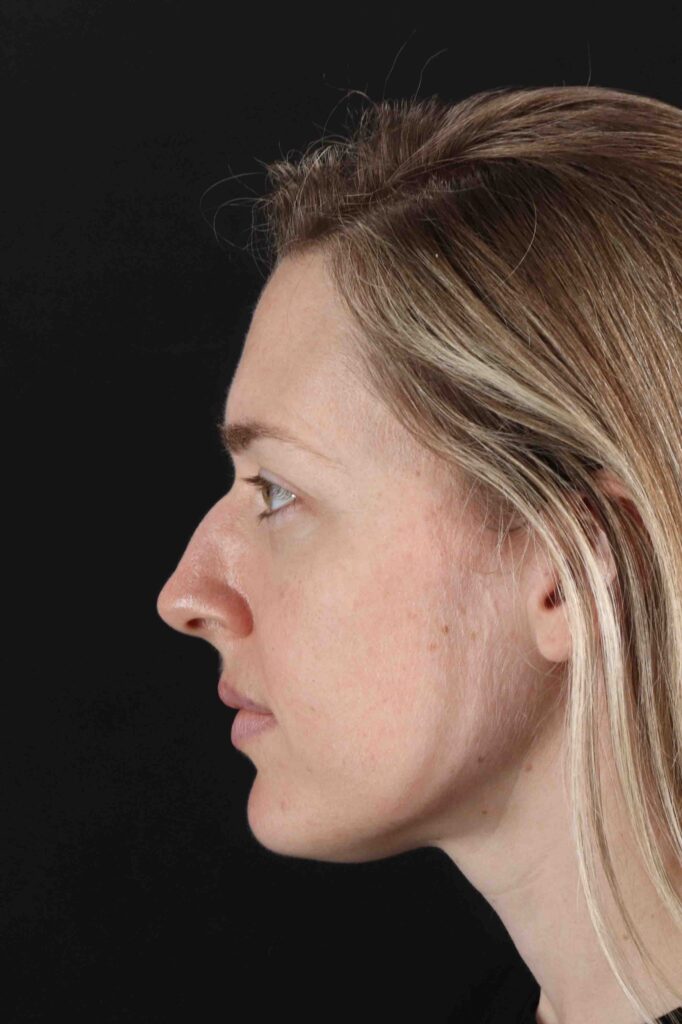 Before - left_lateral