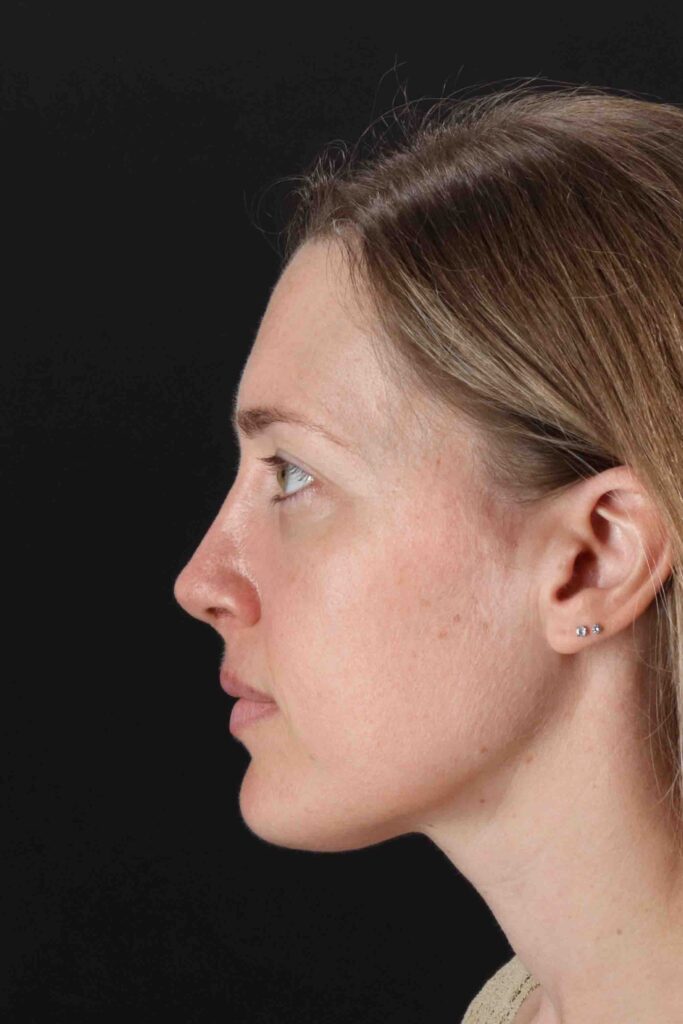 After - left_lateral