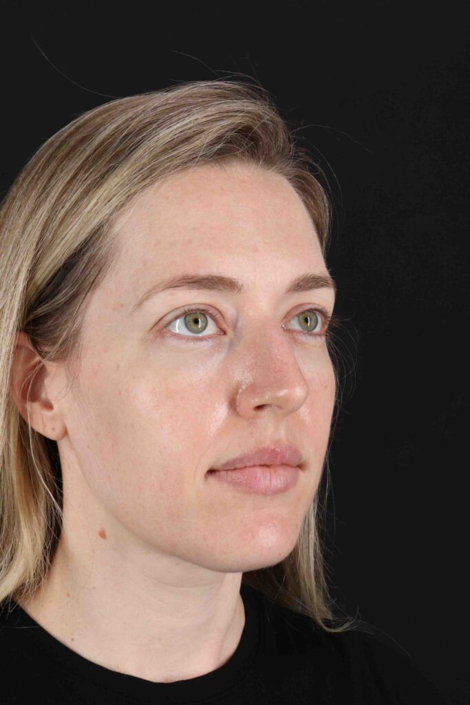 Before - right_oblique