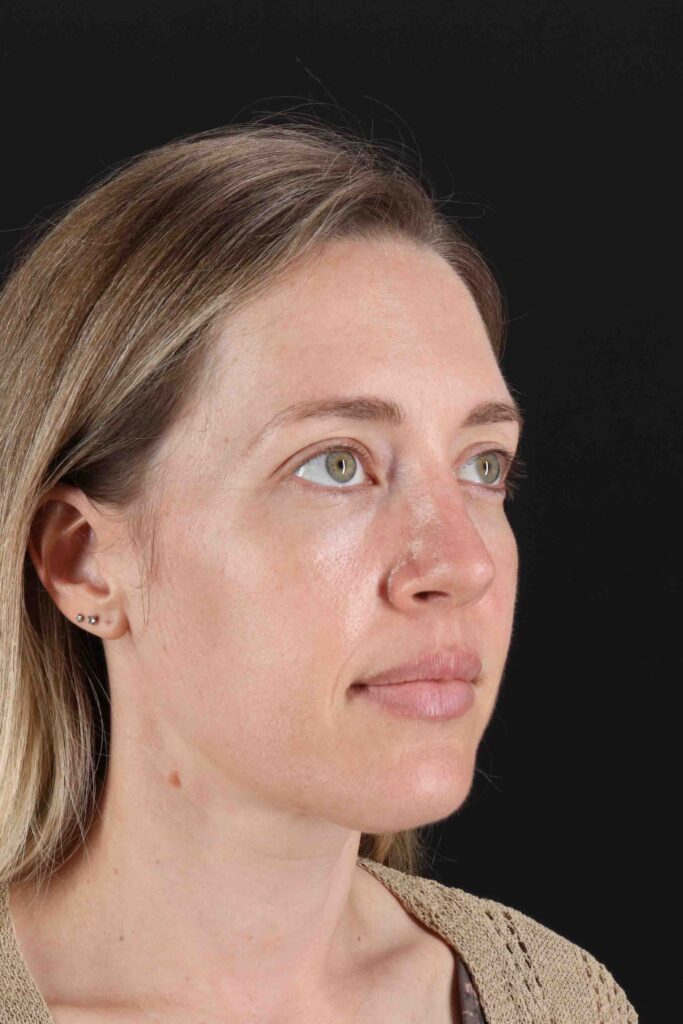 After - right_oblique