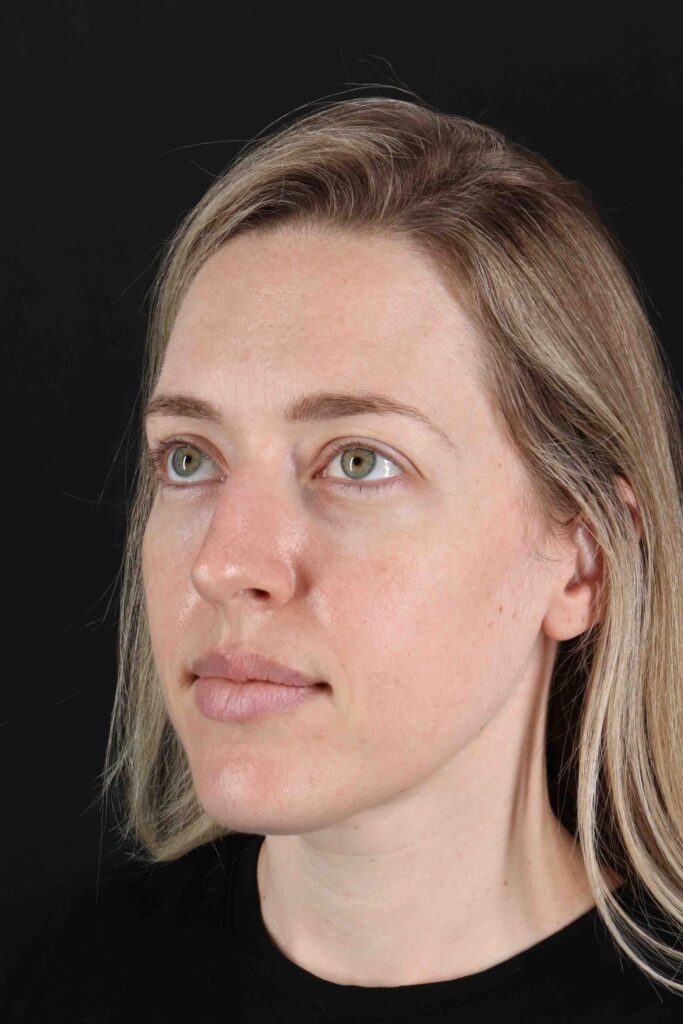 Before - left_oblique