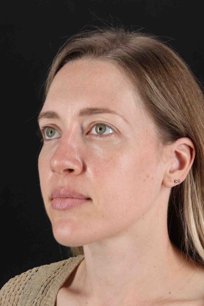 After - left_oblique