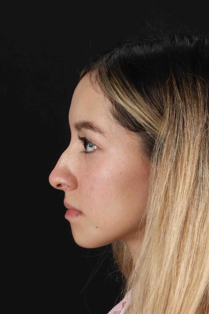 Before - left_lateral