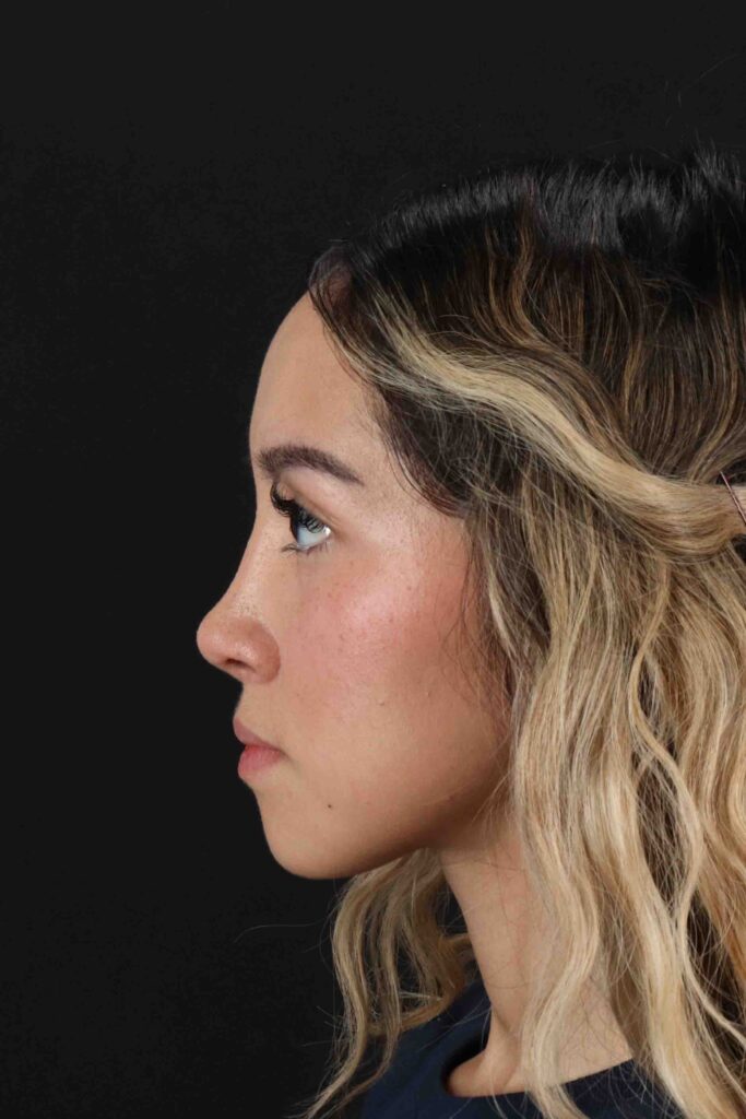 After - left_lateral