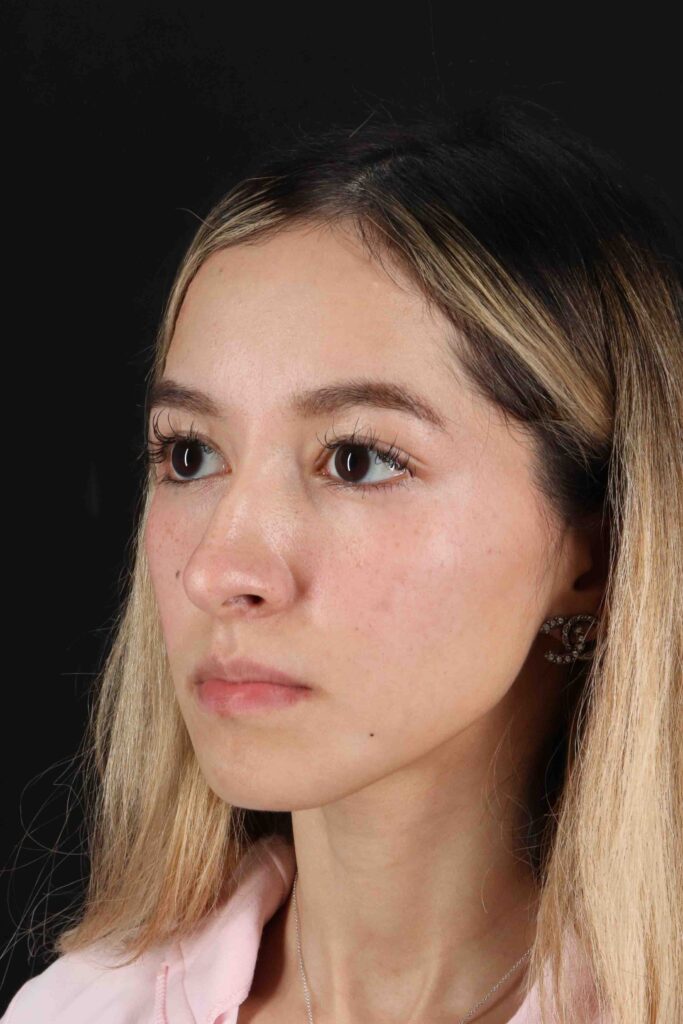 Before - left_oblique