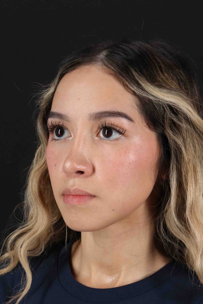 After - left_oblique