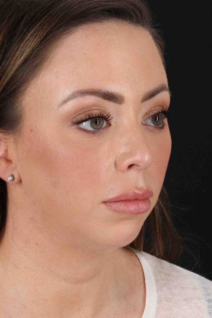 Before - right_oblique