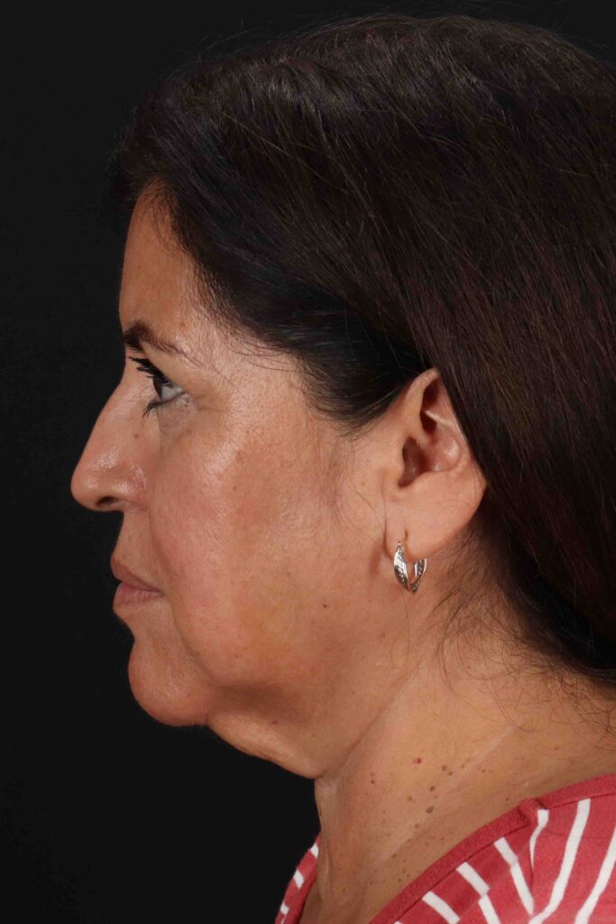 Before - left_lateral