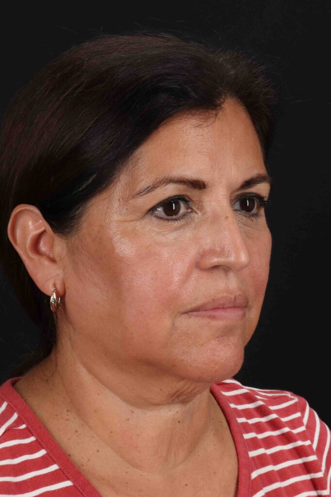 Before - right_oblique