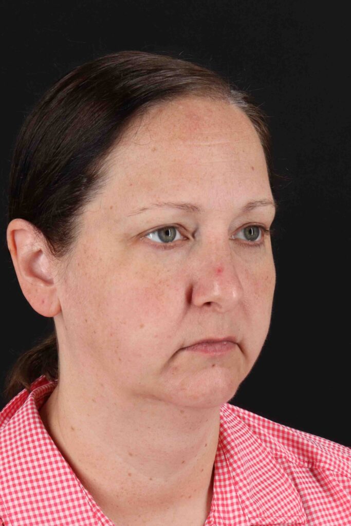 Before - right_oblique