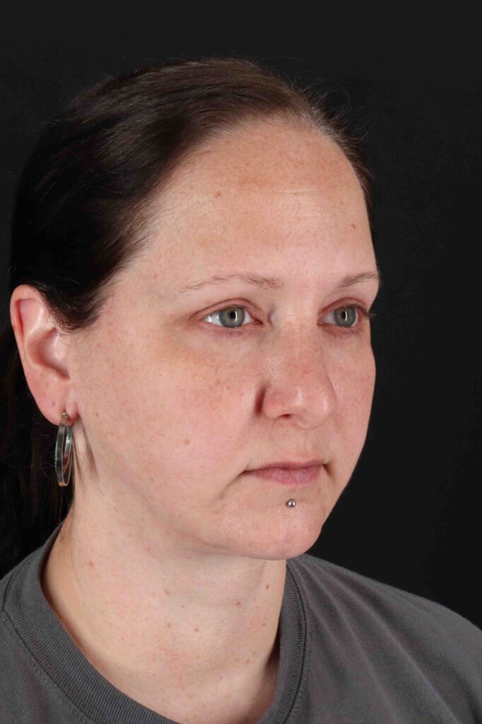 After - right_oblique