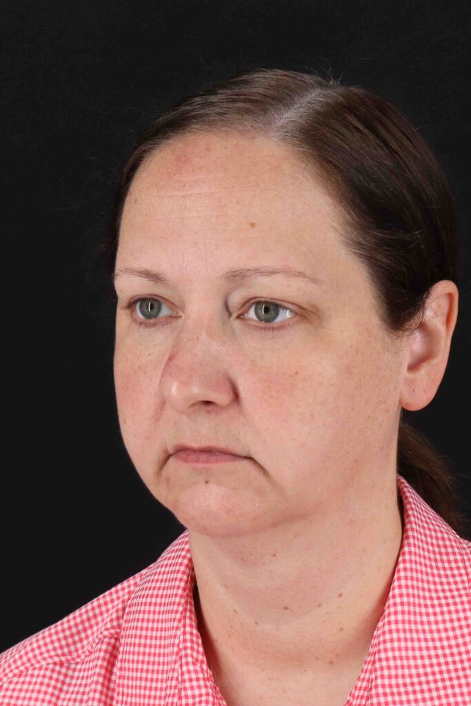 Before - left_oblique