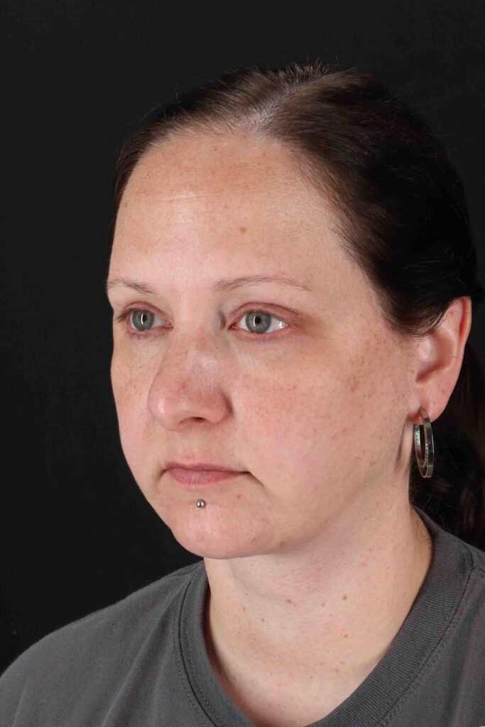 After - left_oblique