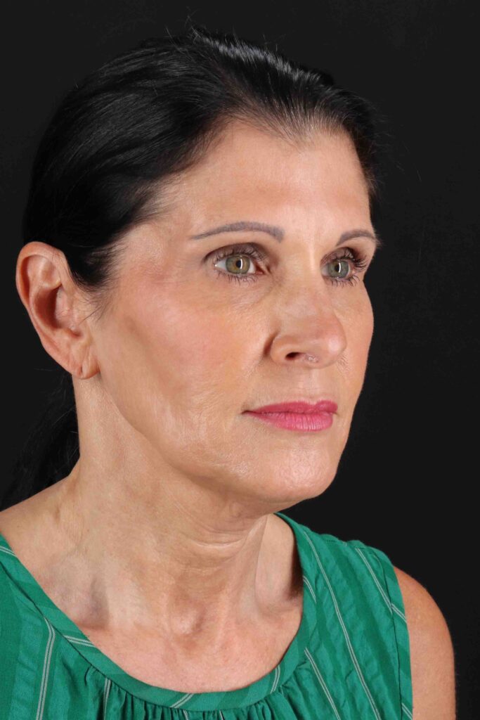 Before - right_oblique