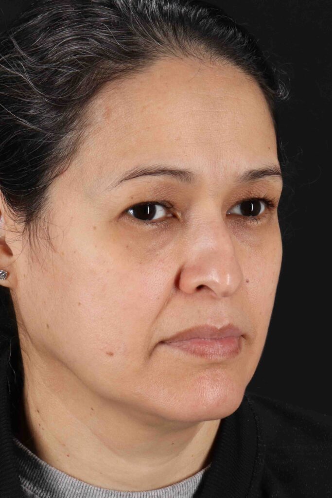 Before - right_oblique