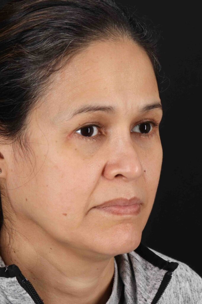 After - right_oblique