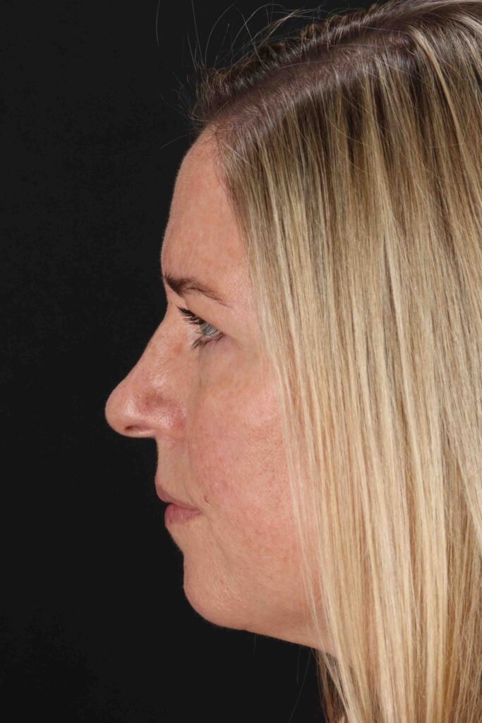 Before - left_lateral