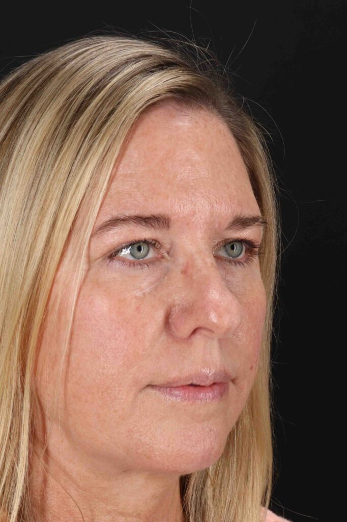 Before - right_oblique