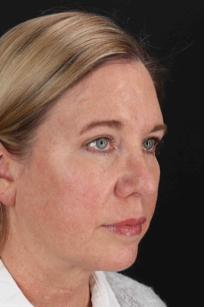 After - right_oblique