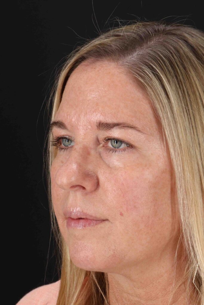 Before - left_oblique