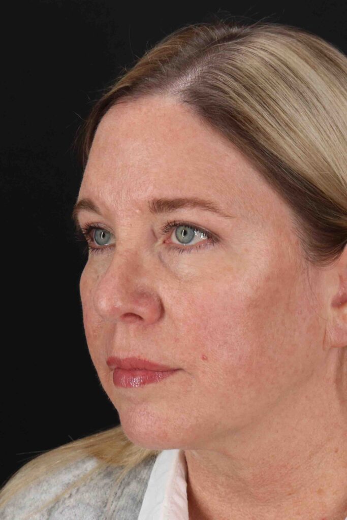 After - left_oblique