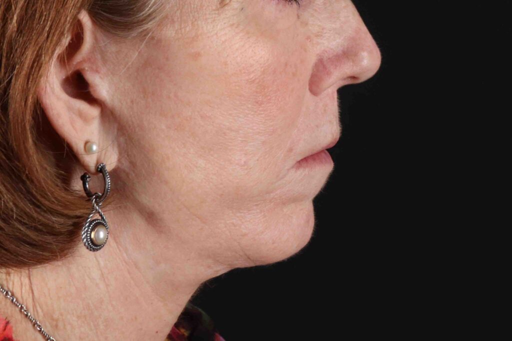 Before - right_lateral