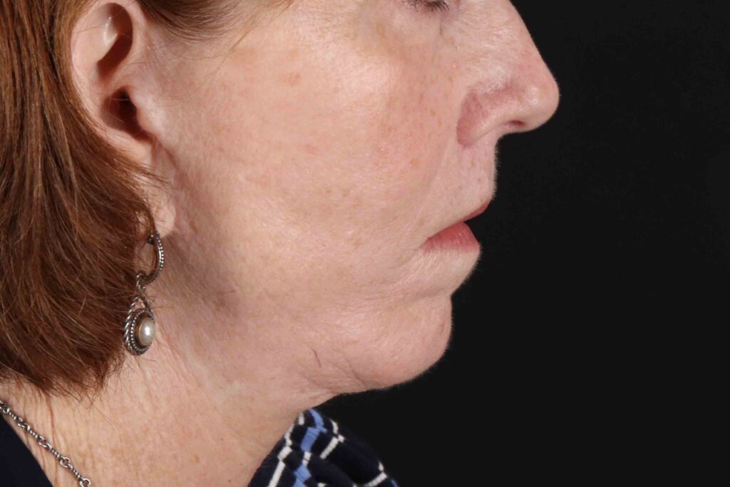 After - right_lateral