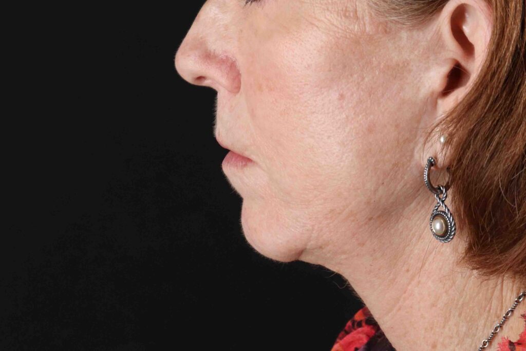 Before - left_lateral