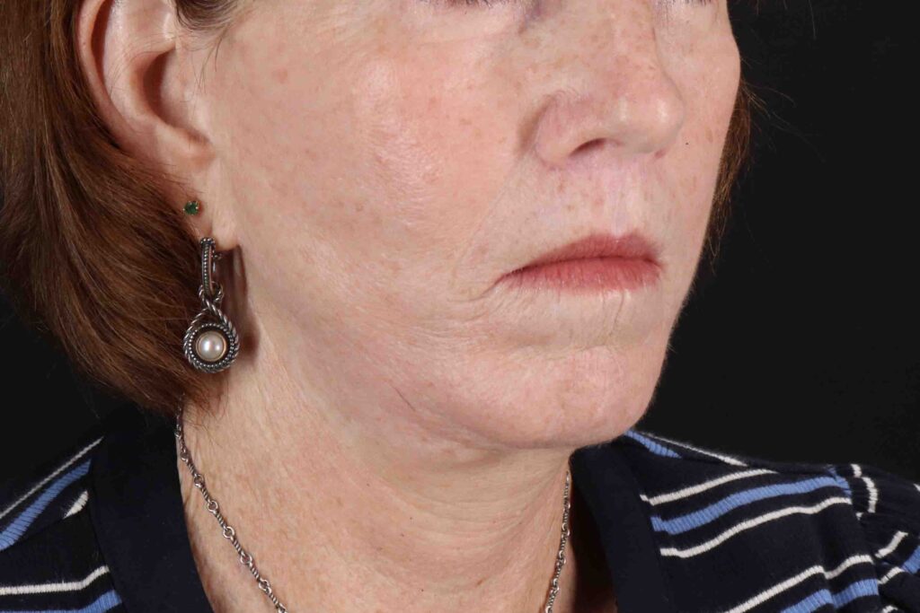 After - right_oblique