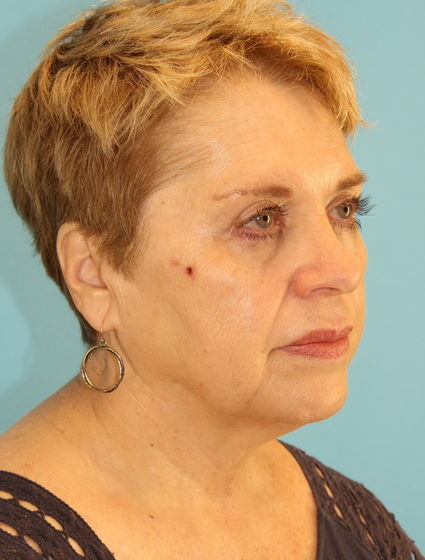 Before - right_oblique