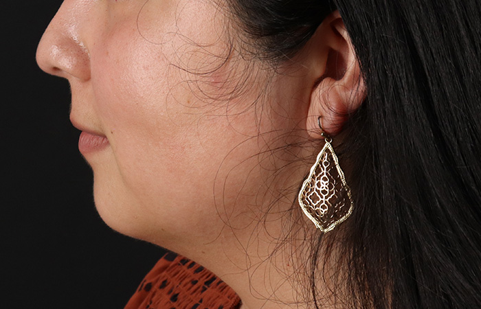 Before - left_lateral