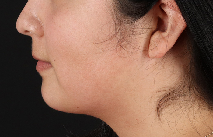 After - left_lateral