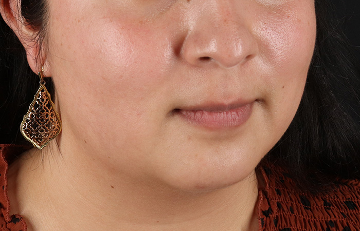 Before - right_oblique