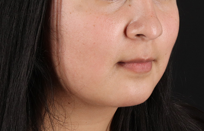 After - right_oblique