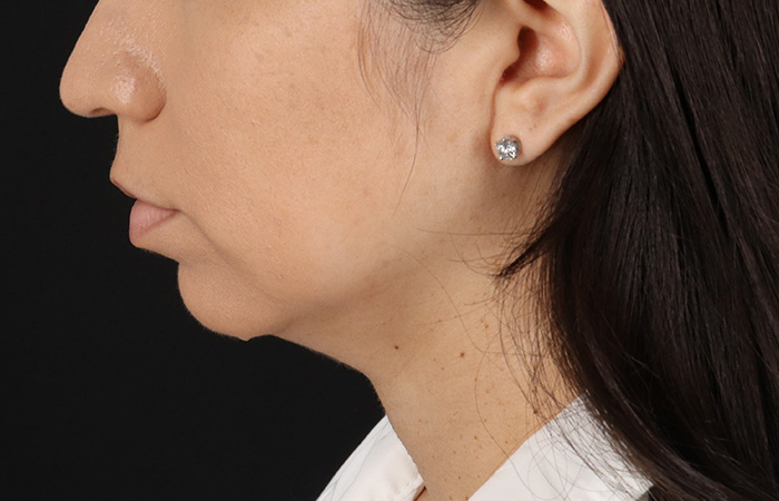 Before - left_lateral