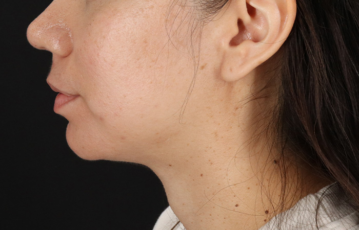 After - left_lateral